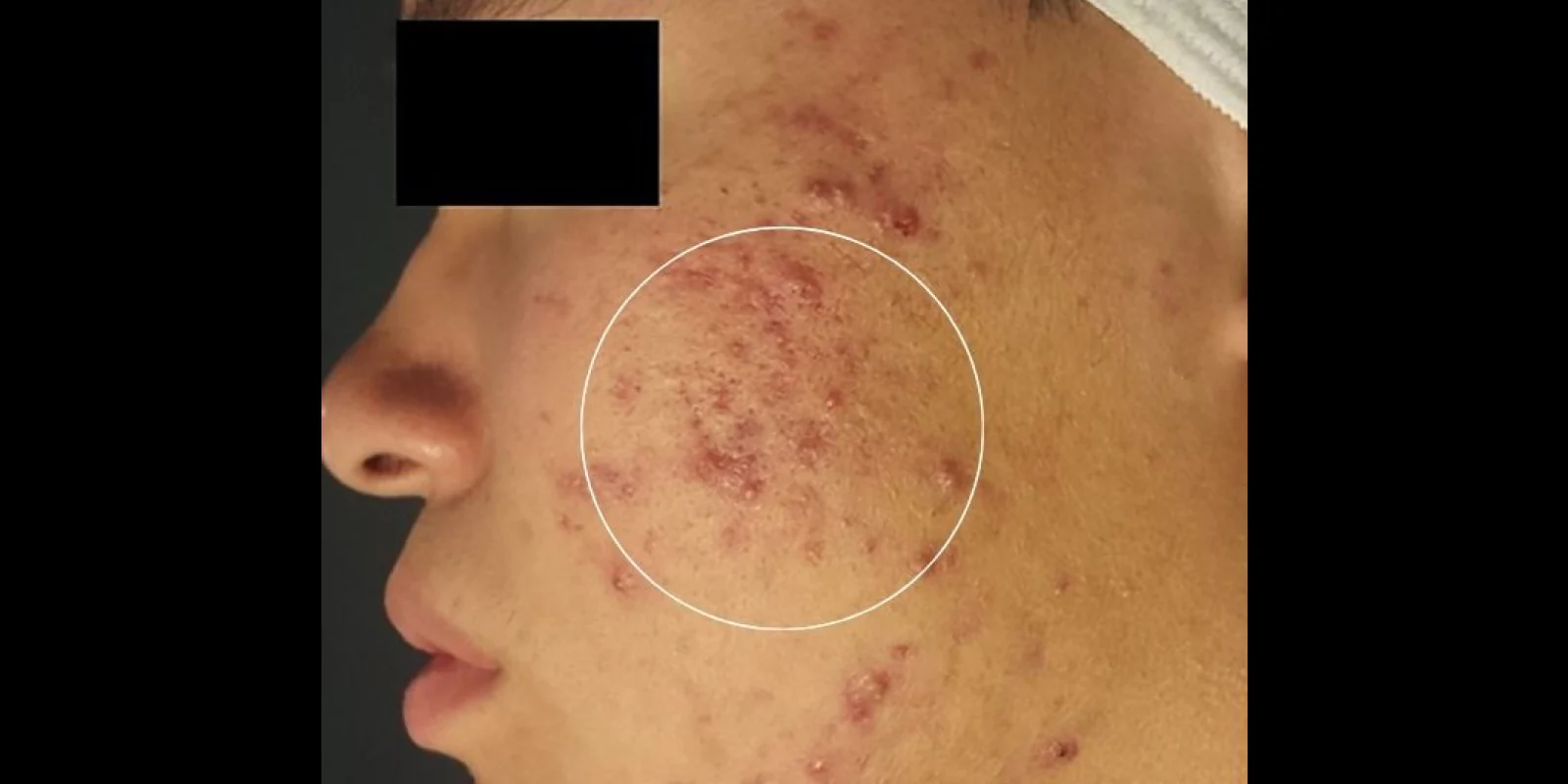 Преди лечение на акне