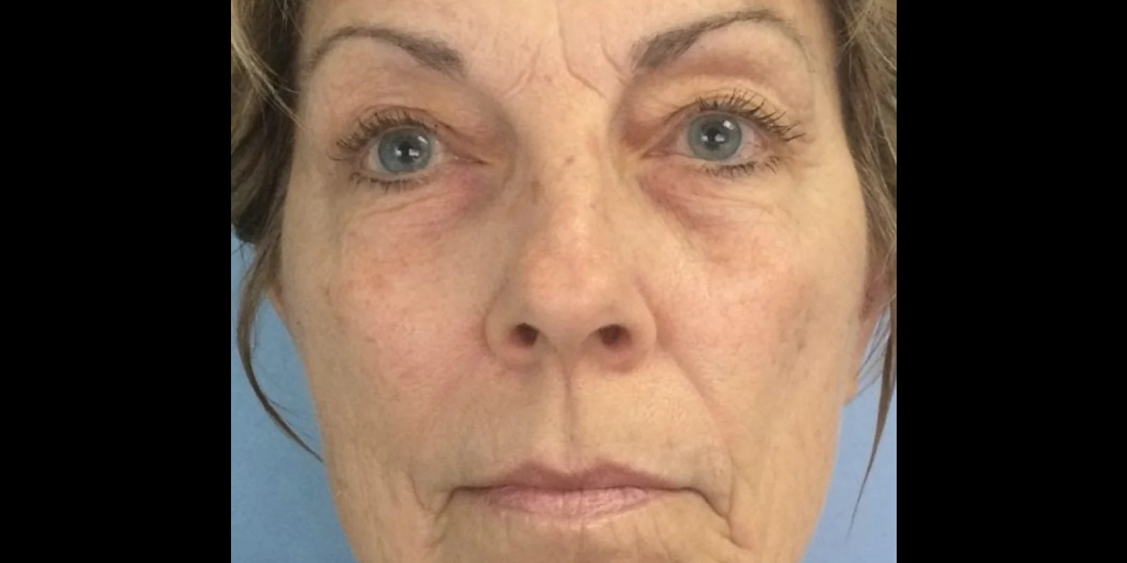 След терапия за бръчки