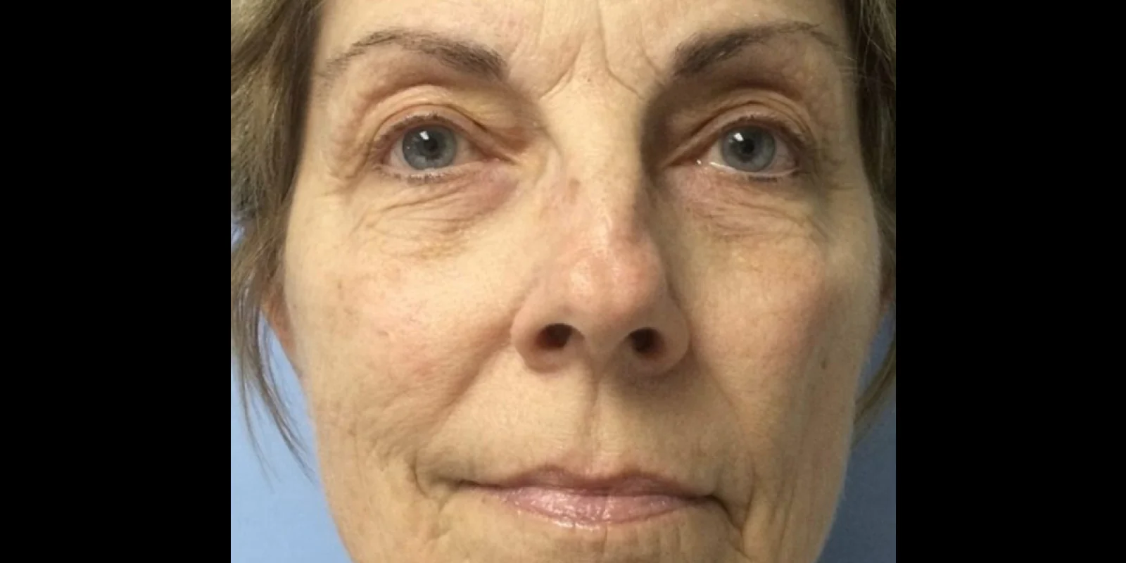 Преди терапия за бръчки