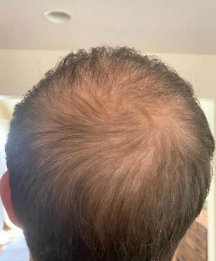 След терапия за растеж на коса