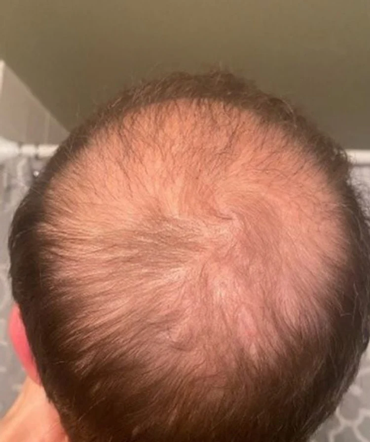 Преди терапия за растеж на коса