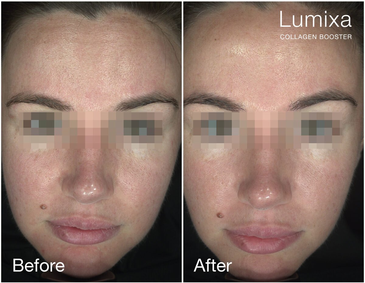 Lumixa Collagen Booster преди и след