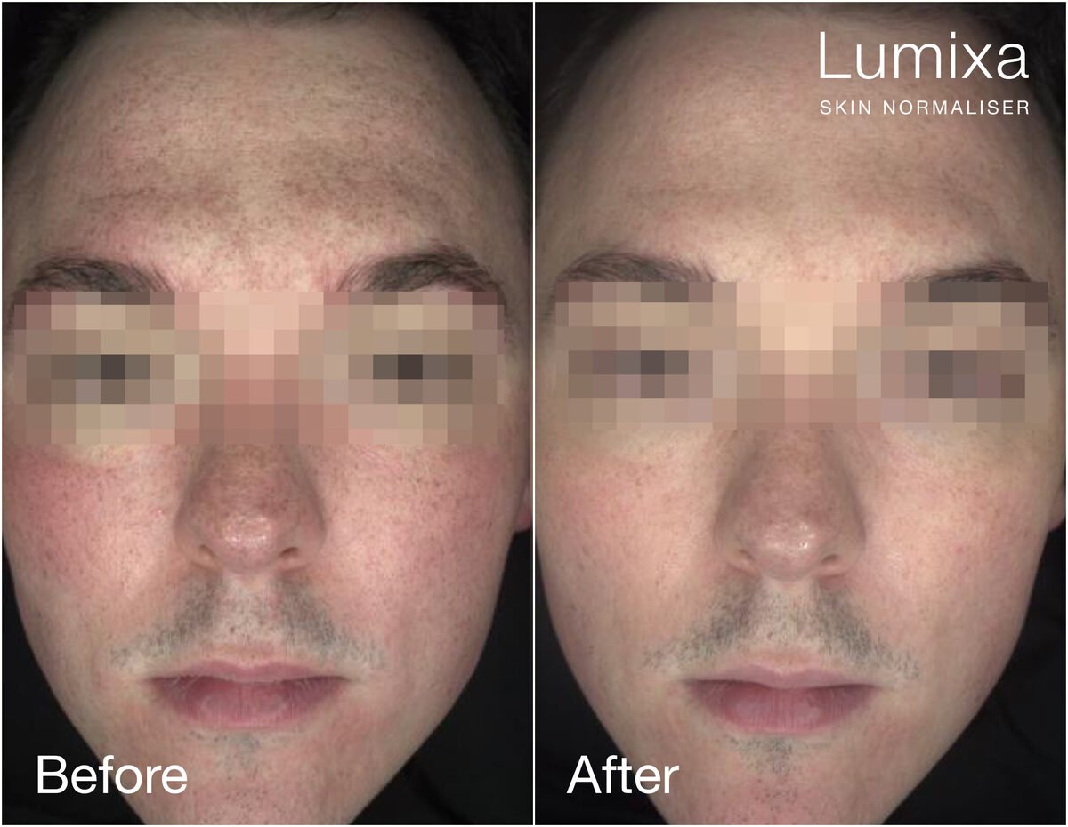 Lumixa Skin Normaliser преди и след
