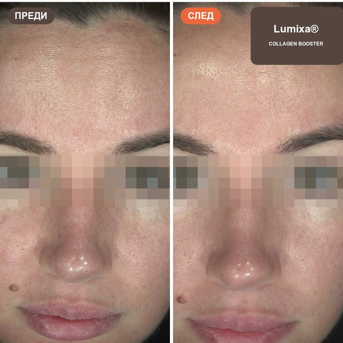 Lumixa Collagen Booster преди и след
